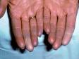 This image displays the blue color of the fingers typical of Raynaud's disease due to the constriction of blood vessels.