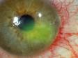 Recurrent Corneal Erosion in Adults: Condition, Treatments, and Pictures - Overview | skinsight