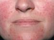Rosacea can cause redness and dilated blood vessels, as displayed in this image.