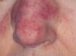 Rosacea is often characterized by small pimple-like pus-filled lesions (pustules) and red bumps.