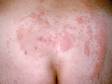 This image displays the red slightly elevated lesions typical of sacral herpes simplex.