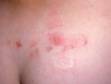 This image displays grouped lesions typical of sacral herpes simplex.
