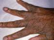 The red bumps typical of scabies are harder to see on the back of the fingers and hands in people with darker skin, as displayed in this image.