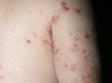 This image displays lesions that have been severely scratched due to a prolonged scabies infection.