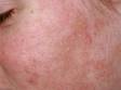 The fine, scaly, slightly elevated lesions of seborrheic dermatitis can be widespread on the face and scalp.