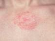 Seborrhiec dermatits can affect the upper chest and have round, red areas in addition to slight scaling.