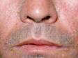 This image displays severe seborrheic dermatitis in the skin creases between the cheeks and the upper lip.