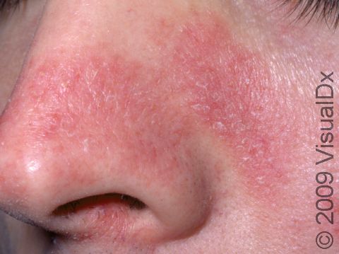 The Top 10 Common Causes Of Face Rash Skinsight