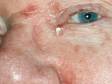 The base of the nose and central face tends to be involved in seborrheic dermatitis.
