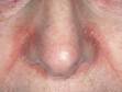 Redness and scaling often wraps around the nose in people with severe seborrheic dermatitis.
