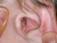 The red, scaling, and itching associated with seborrheic dermatitis are common in the ear canal.