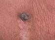 Seborrheic keratoses are harmless thickenings of the outer layer of skin.