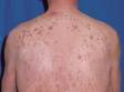 This image displays multiple brown, slightly elevated lesions typical of seborrheic keratoses.
