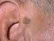 Seborrheic keratoses are common, benign skin lesions in adults. They have a "stuck on" and rough surface appearance.