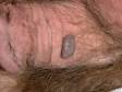 This image displays the waxy and stuck-on appearing, elevated lesion typical of a seborrheic keratosis.