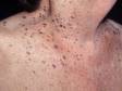 The dark to light brown raised, rough areas of seborrheic keratoses may be numerous in the elderly.