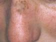 The multiple small, light brown freckles seen here reflect sun damage, but the darker, larger spot on the upper nose bridge is a rough, scaling seborrheic keratosis.