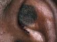 Dark brown, rough seborrheic keratoses may be found on any skin area, even inside the ear rim.