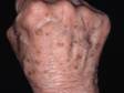 The backs of the hands commonly have solar lentigines (mistakenly called ?liver spots?).