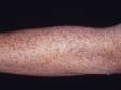 The highly sun-exposed back of the forearm shows more numerous solar lentigines than the inner forearm.