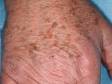 The medical term for sun and age freckles, as seen here, is solar lentigos.