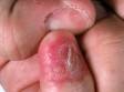 Squamous cell carcinoma can involve the fingertip and begin under the fingernail, as displayed here.