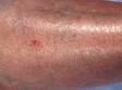 Squamous cell carcinoma can appear as a persistent, red, scaly lesion easily mistaken for an area of inflamed skin (dermatitis).