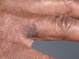 This image displays a squamous cell carcinoma on a black patient, which is infrequent.
