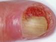 Squamous cell carcinoma can involve the fingertip and begin under the fingernail, as seen in this image.