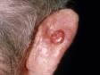 Squamous cell carcinomas, a type of skin cancer, can appear as a round, red mass, typically on a sun-exposed location.