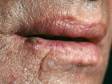 This image displays a crusting and bleeding lesion on the lower lip typical of squamous cell carcinoma.