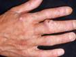 This image displays multiple areas of sun damage and a large squamous cell carcinoma on the middle finger.