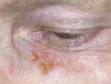 A squamous cell carcinoma is often hard to distinguish from an actinic keratosis, which is its precursor.