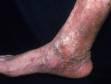 This image displays long-standing stasis dermatitis and varicose veins associated with swelling and inflammation in the skin.