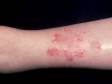This image displays an early case of stasis dermatitis.