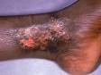 This image displays foot and ankle swelling and inflammation typical of stasis ulcers.