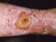 This image displays a large, superficial ulcer within a red, elevated lesion typical of stasis dermatitis.