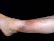 This image displays a patient with chronic leg swelling with stasis dermatitis and a stasis ulcer.