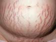 Dark purple, linear stretch marks (striae) are common on the belly of pregnant women.