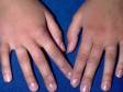 This image displays redness and small blisters on the tops of hands and fingers typical of sunburn.