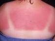 This image displays a patient with a sunburn.