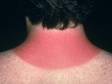 This image displays a sunburn.