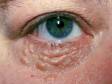 This image displays the cobblestone appearance of the skin under the eyes typical of multiple syringomas.