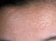 This image displays syringomas on the forehead.
