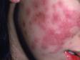 This image displays how inflammation in systemic lupus can be intense, causing very red skin lesions.