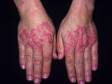 This image displays a case of lupus on the backs of the hands, worsened by sun exposure.