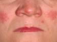 This image displays the red, slightly scaly, and elevated lesions on the cheeks and nose in systemic lupus erythematosus.