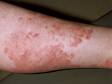 Multiple scaly, slightly elevated lesions can merge to form broad reddish-brown areas of skin.