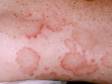 This image displays ring-like, red, scaly lesions that are slightly elevated, typical of tinea corporis (fungal skin infection).