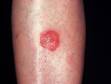 This early patch of ringworm (tinea) on the leg has the typical circular shape.